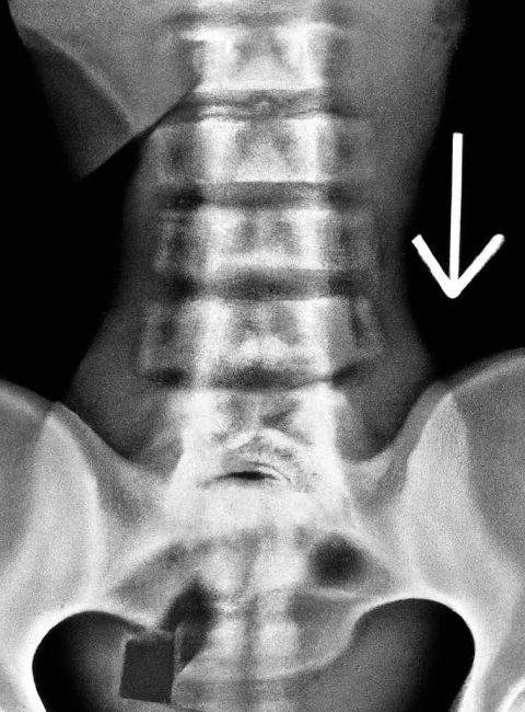 deviazione-laterale-della-colonna-vertebrale-scoliosi-diagnosi-e-interventi-correttivi